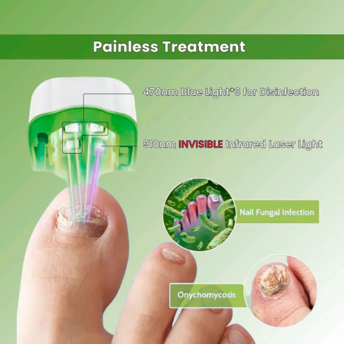 PrevaZen™ - Nail Fungus Laser