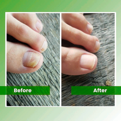 PrevaZen™ - Nail Fungus Laser
