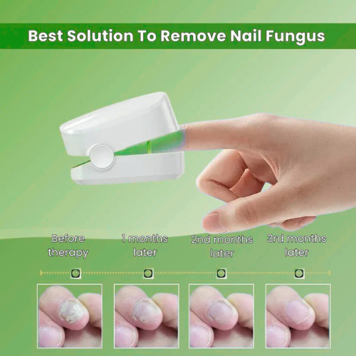 PrevaZen™ - Nail Fungus Laser